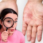 “Herpes Zóster: La Amenaza Latente Tras la Varicela” "Herpes Zóster: La Amenaza Latente Tras la Varicela"